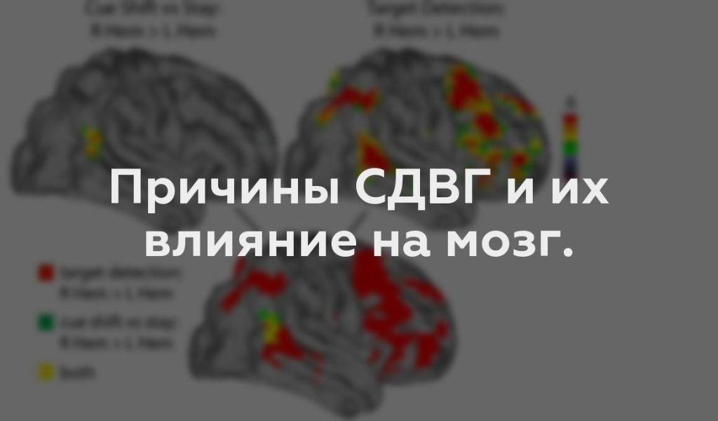 Причины СДВГ и их влияние на мозг.